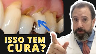 Desgaste no colo dos dentes⎮Causas e Solução ⎮Abfração dentária [upl. by Jayme780]