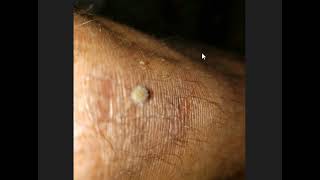 Dry Skin Why  Morgellons Decease  The silent pandemic  Aspergillus Fumigatus [upl. by Ariam622]