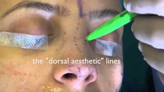 Rhinoplasty Surface Aesthetics and Surgical Techniques [upl. by Korie]