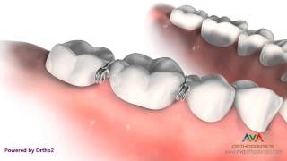 Orthodontic Separator or Spacer  Metal Helix [upl. by Deevan]