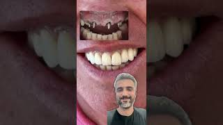 Implante dentário dentista odontologia [upl. by Hahn]