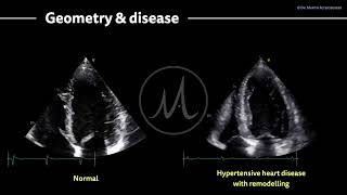 〖Echocardiography〗 Hypertensive heart disease amp the left ventricle [upl. by Pelaga]