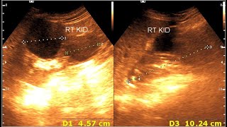 Renal cortical cyst  Milk of calcium cyst  Renal calcification [upl. by Conlan296]