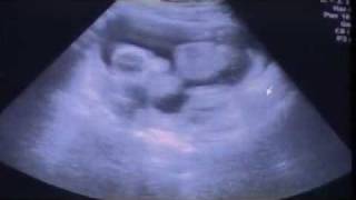 15 WEEKS PREGNANT ULTRASOUND ITS A GIRL [upl. by Netsreik499]