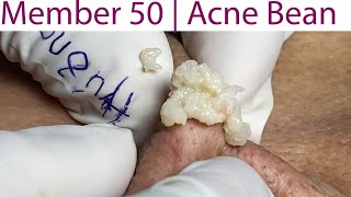 Acne Treatment Huong Da Nang 051  weekend  2023 [upl. by Annaer]