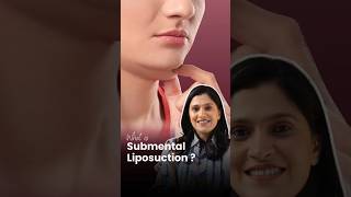 What is Submental Liposuction   Dr Amiti Shah reducedoublechin shorts [upl. by Gustaf]