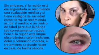 👉 CURAR UN OJO MORADO 👌 3 pasos para tratar y eliminar Moretones o Hematoma facial ✅ [upl. by Megan]