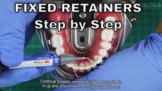 Fixed Retainer Step by Step [upl. by Somerset]