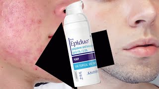 COMO CURE MI ACNE CON PEROXIDO DE BENZOLIO Y ADAPALENO Epiduo 100 EFECTIVO [upl. by Pooi105]