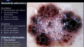 QUERATOSIS SEBORREICAS  Dra Paula Friedman [upl. by Eseilana]