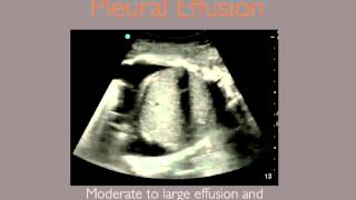 Pleural Effusion Ultrasound Sonoguide [upl. by Nodearb]