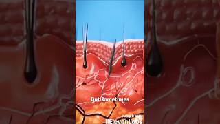 How splinter get unstuck skincare splinter doctor splintertalk animation extraction splint [upl. by Dett15]