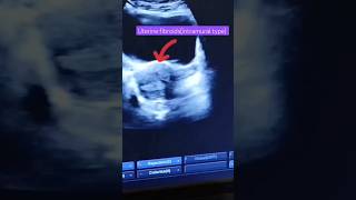 Uterine fibroidsultrasound imagesfibroidsintramural typeytshortshortvideo [upl. by Xxam525]