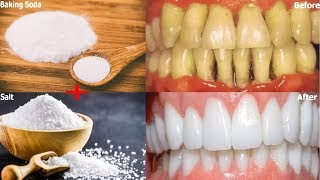 How to beautiful your teeth with baking soda and salt home remedies [upl. by Flyn]