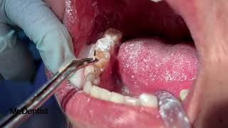 Root Canal Treatment  PART 3 [upl. by Mount]