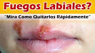 COMO QUITAR EL HERPES LABIAL RAPIDO Remedios Caseros Para Los Fuegos Labiales o Herpes Labiales [upl. by Enialahs]