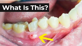 What is an Abscessed Tooth amp What To Do About It [upl. by Alicia523]