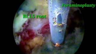 Percutaneous endoscopic Foraminoplasty and disc removal on L5S1 with high iliac crest [upl. by Pol]