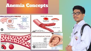 Iron Deficiency Anemia Hemolytic Anemia  Effects of Anemia on Heart [upl. by Ainigriv]