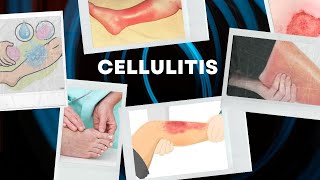 Cellulitis Symptoms and Homeopathic Treatment [upl. by Cesar597]