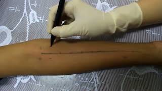 Skin Prick Test Tes Alergi [upl. by Coopersmith]