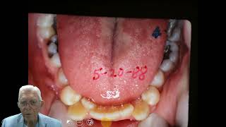 Double Jaw Surgery  Second Case [upl. by Heyes437]