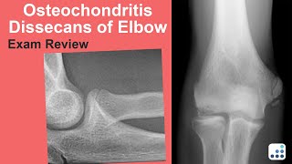 Osteochondritis Dissecans of Elbow Exam Review  Christopher S Ahmad MD [upl. by Morissa]