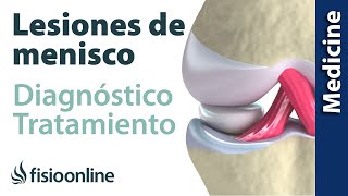 😩😩ROTURA DE MENISCO ► Diagnóstico y tratamiento de fisioterapia médico y quirúrgico [upl. by Eri]