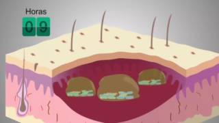 Vídeo explicativo sobre los Biofilms y como actúa Prontosan [upl. by Eceirehs98]