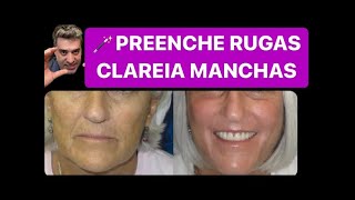 USE NAS RUGAS 20X MAIS POTENTE QUE BOTOX  Preenche Rugas e Clareia Manchas  DR RENATO SILVEIRA [upl. by Ayhdnas443]