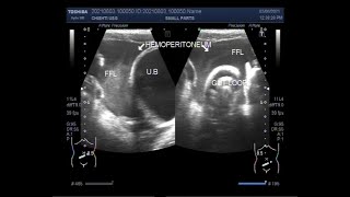 Hemoperitoneum due to Blunt trauma in a traffic accident [upl. by Nuawtna]