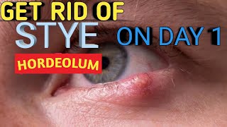 Stye removal at home  Chalazion draining  Chalazion treatment  stye eye pop  hordeolum treatment [upl. by Rolyab]