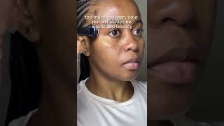 Here are the reason why you shouldnt do microneedling at home acne microneedling skincaretips [upl. by Eelarual193]