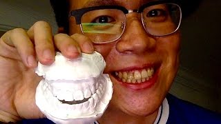 My Double Jaw Surgery Journey  POD 5 months 24 days Ouch retainers [upl. by Jeffie]