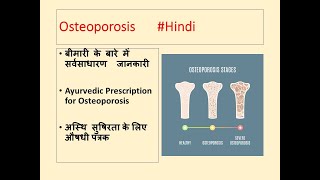 Osteoporosis l Ayurvedic Treatment of Osteoporosis l अस्थिसुषिरता की चिकित्सा l hindi [upl. by Delp252]