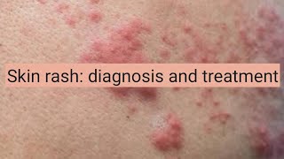 Skin Rash diagnosis and treatment [upl. by Lathrop742]