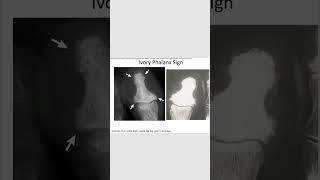 Ivory phalanx signpsoriasisradiology revision neetpg inicet [upl. by Aryamoy]