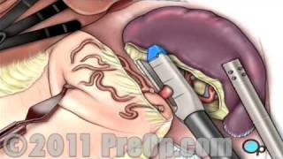 Spleen Removal Surgery Laparoscopic Splenectomy PreOp® Patient Education [upl. by Eentruoc351]