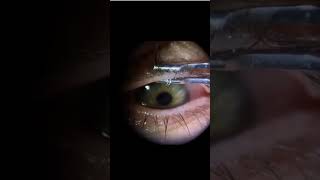 Meibomian gland expression shorts viral education optometrists ytshortsindia eye eyecare [upl. by Hasan16]