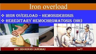 Lecture 18 Iron over Load and Hemochromatosis [upl. by Yesdnyl603]