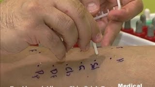 Allergy Skin Prick Test by Dr Ahmad AlKhabaz كيفية فحص الحساسية بالخدش د أحمد الخباز [upl. by Merell]