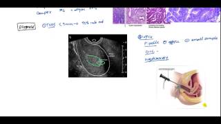 Endometrial Cancer and Hyperplasia for USMLE [upl. by Eulaliah470]