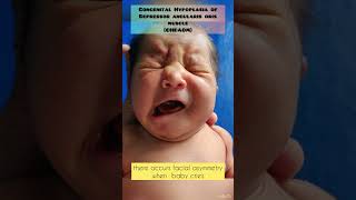 congenital absence of depressor angularis oris muscle  cryingbaby nicu shorts [upl. by Meijer]