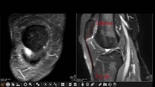 Patellar tendonlateral femoral condyle friction syndrome Hoffa fat pad impingement syndrome [upl. by Johnna710]