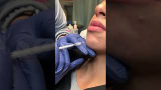 Dysport Injection Treatment for Reduce Chin Wrinkles San Diego shorts [upl. by Jacinta]