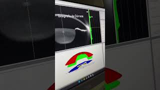 Topografia de Córnea [upl. by Esirahs]