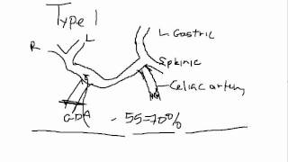 Whipple Procedure Hepatic Arterial Anatomy [upl. by Della700]