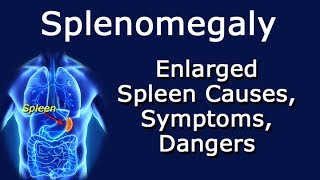 Splenomegaly Enlarged Spleen Causes Symptoms Dangers [upl. by Littman]