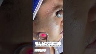 CO2 Fractional Laser Resurfacing for Acne Scars shorts [upl. by Racso]