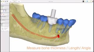 AxisGuide® Plan Implant Planning software FREE [upl. by Adnim]